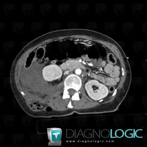 Hematoma, Retroperitoneum, CT