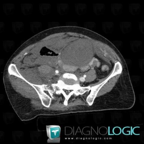 Hematoma, Retroperitoneum, CT