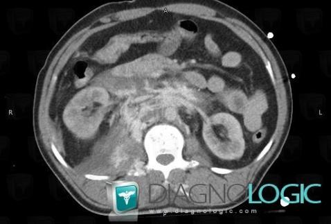 Hematoma, Retroperitoneum, CT