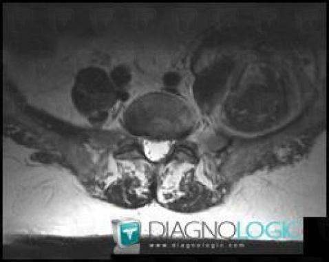 Hematoma, Retroperitoneum, MRI