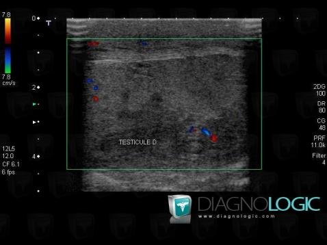 Hematoma, Scrotum, US