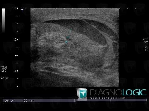 Hematoma, Scrotum, US