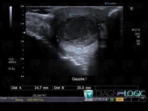 Hematoma, Scrotum, US