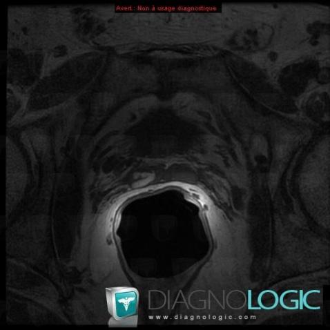 Hematoma, Seminal vesicles, MRI