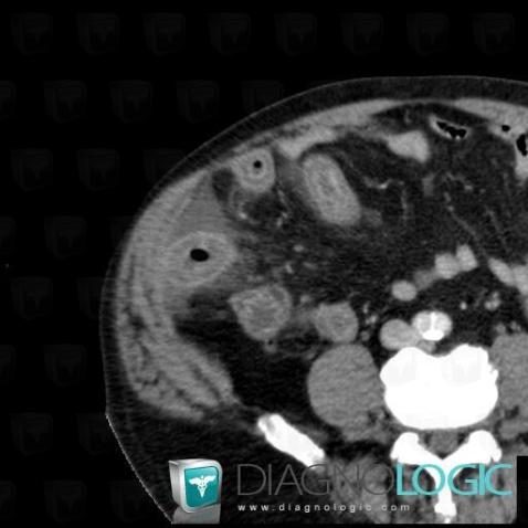 Hematoma, Small bowel, CT