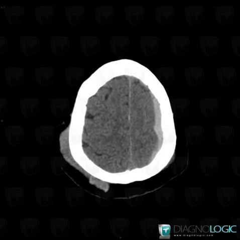 Hematoma, Soft tissues - Skull, CT