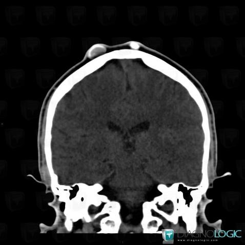 Hematoma, Soft tissues - Skull, CT