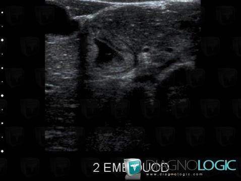 Hématome, Duodénum, Echographie