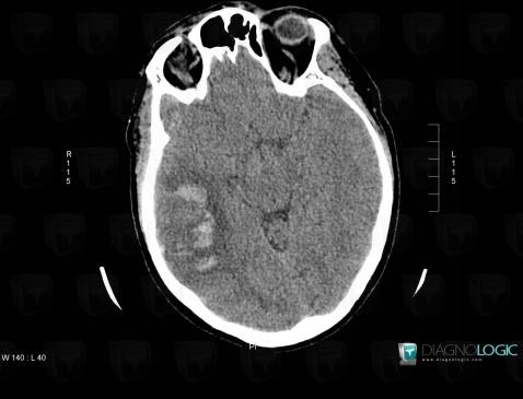 Hématome, Hémisphères cérébraux, Scanner