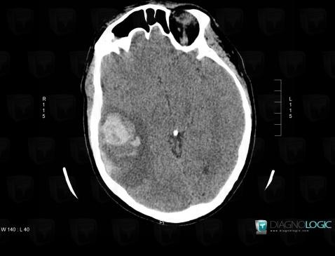 Hématome, Hémisphères cérébraux, Scanner