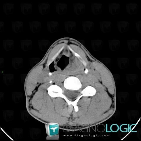 Hématome, Larynx, Scanner