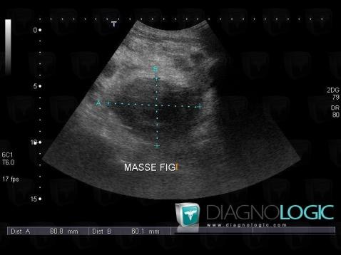 Hématome, Pelvis / Périnée, Echographie