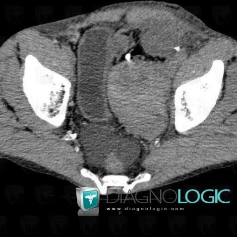 Hématome, Pelvis / Périnée, Scanner