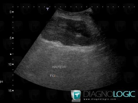 Cas radiologie : Hématome (Echographie ,Scanner) - Diagnologic