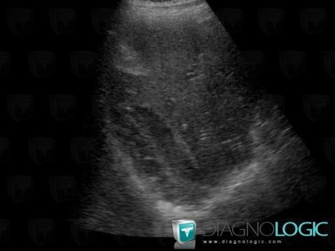 Hématome sous capsulaire, Foie, Echographie