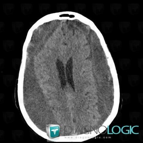 Hématome sous-dural , Espaces peri cérébraux supratentoriels, Scanner