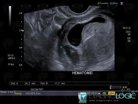 Hématome, Utérus, Echographie