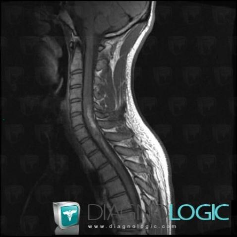 Hematomyelia, Spinal canal / Cord, MRI