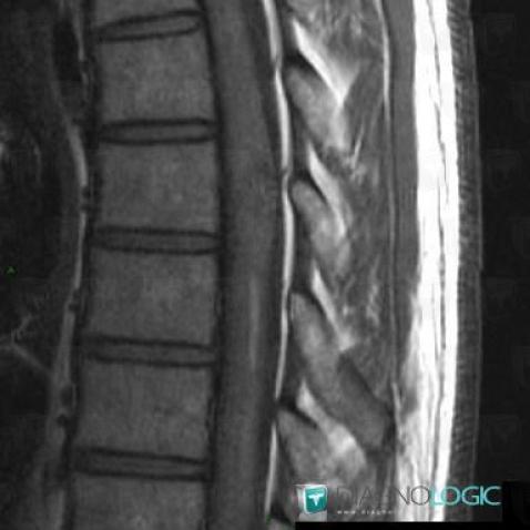 Hematomyelia, Spinal canal / Cord, MRI