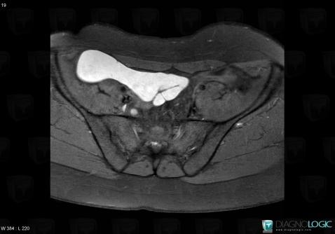 Hematosalpinx, Adnexa / Ovary fallopian tube, MRI