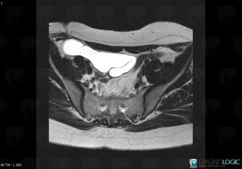 Hematosalpinx, Adnexa / Ovary fallopian tube, Pelvis / Perineum, MRI