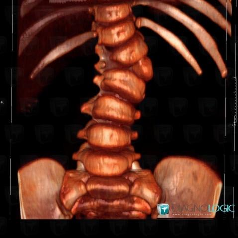 Hemivertebra , Vertebral body / Disk, CT