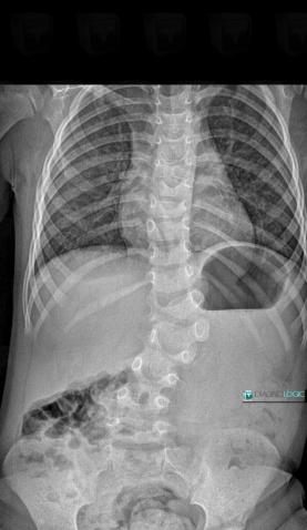 Hemivertebra , Vertebral body / Disk, X rays