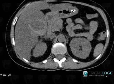 Hemobilia, Gallbladder, CT