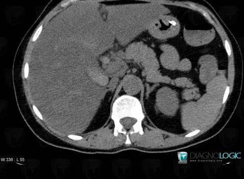 Hemobilia, Intra and extra hepatic bile ducts, CT