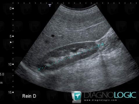 Hémochromatose , Foie, Echographie