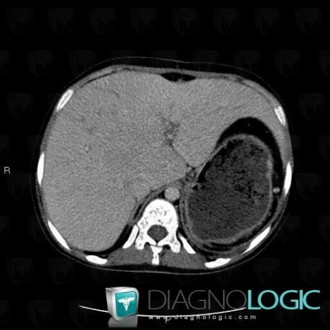 Hemochromatosis, Liver, CT