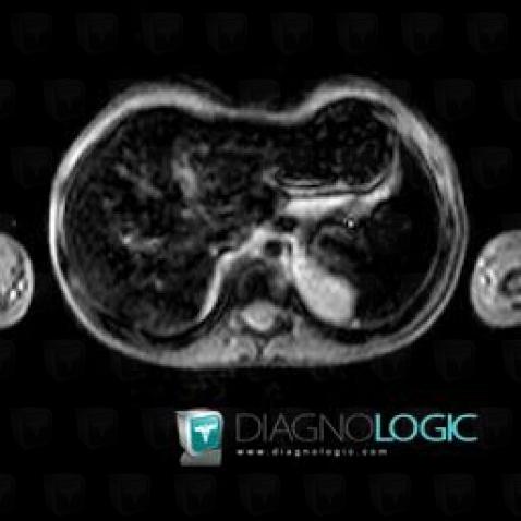 Hemochromatosis, Liver, MRI