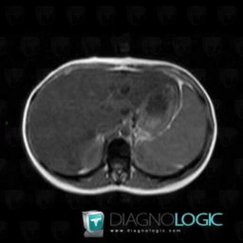 Hemochromatosis, Liver, MRI