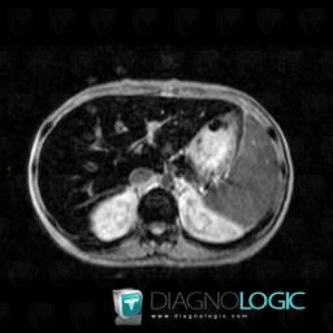 Hemochromatosis, Liver, MRI