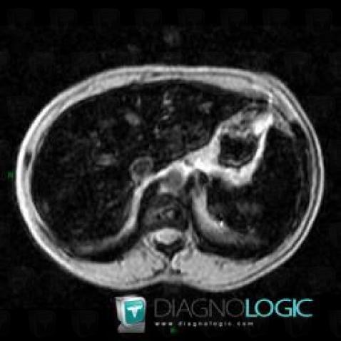 Hemochromatosis, Liver, MRI