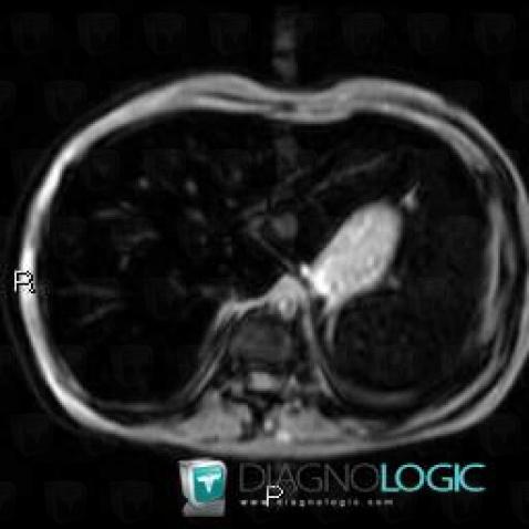 Hemochromatosis, Liver, MRI