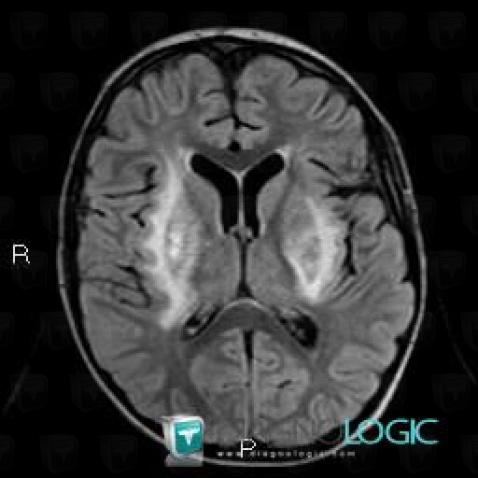 Hemolytic uremic syndrome, Basal ganglia and capsule, MRI