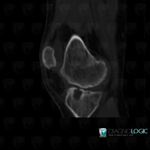 Hemophilia, Femorotibial joints - Intercondylar notch, CT
