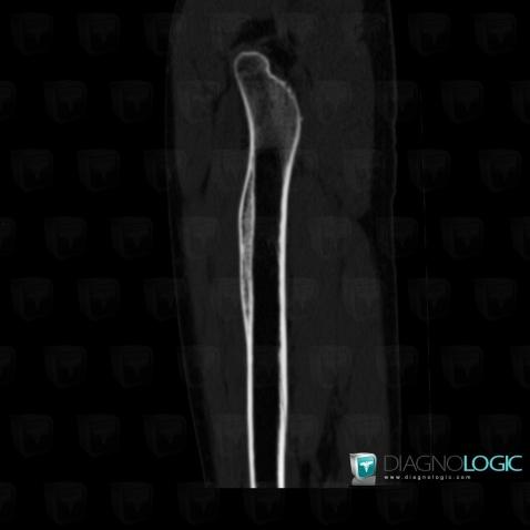 Hemophilia, Femur - Proximal part, Femur - Mid part, CT