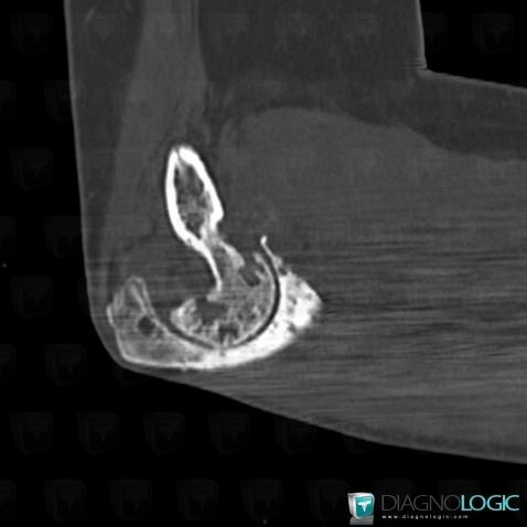 Hemophilia, Joints - Elbow, CT