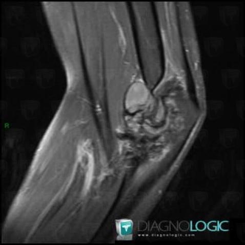 Hemophilia, Joints - Elbow, MRI