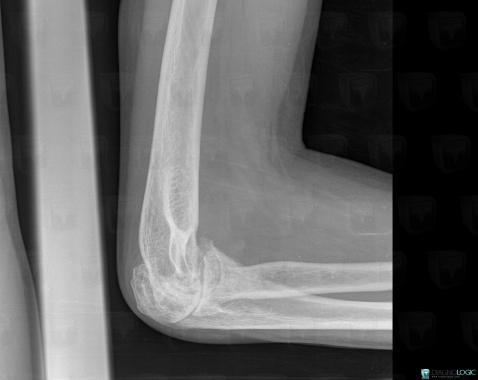 Hemophilia, Joints - Elbow, X rays