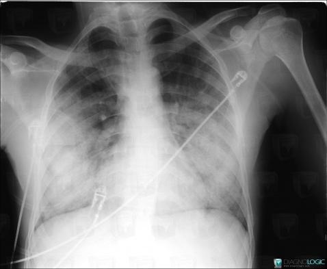 Hémorragie intra alvéolaire, Parenchyme pulmonaire, Radio