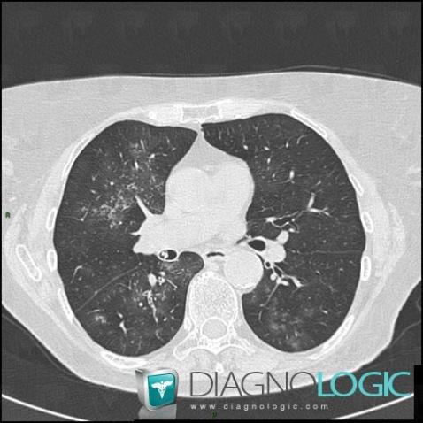 Hémorragie intra alvéolaire, Parenchyme pulmonaire, Scanner
