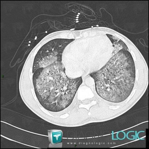 Hémorragie intra alvéolaire, Parenchyme pulmonaire, Scanner