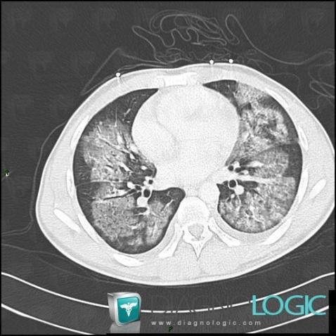 Hémorragie intra alvéolaire, Parenchyme pulmonaire, Scanner