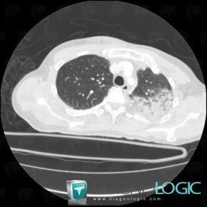 Condensation Alveolaire Localisee Diagnologic