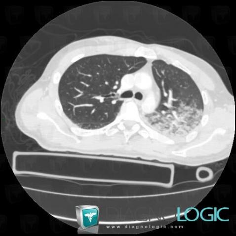 Hémorragie intra alvéolaire, Parenchyme pulmonaire, Scanner