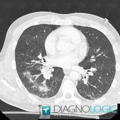 Hémorragie intra alvéolaire, Parenchyme pulmonaire, Scanner