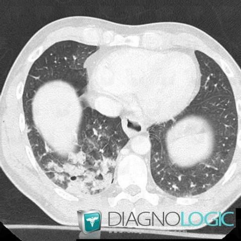 Hémorragie intra alvéolaire, Parenchyme pulmonaire, Scanner